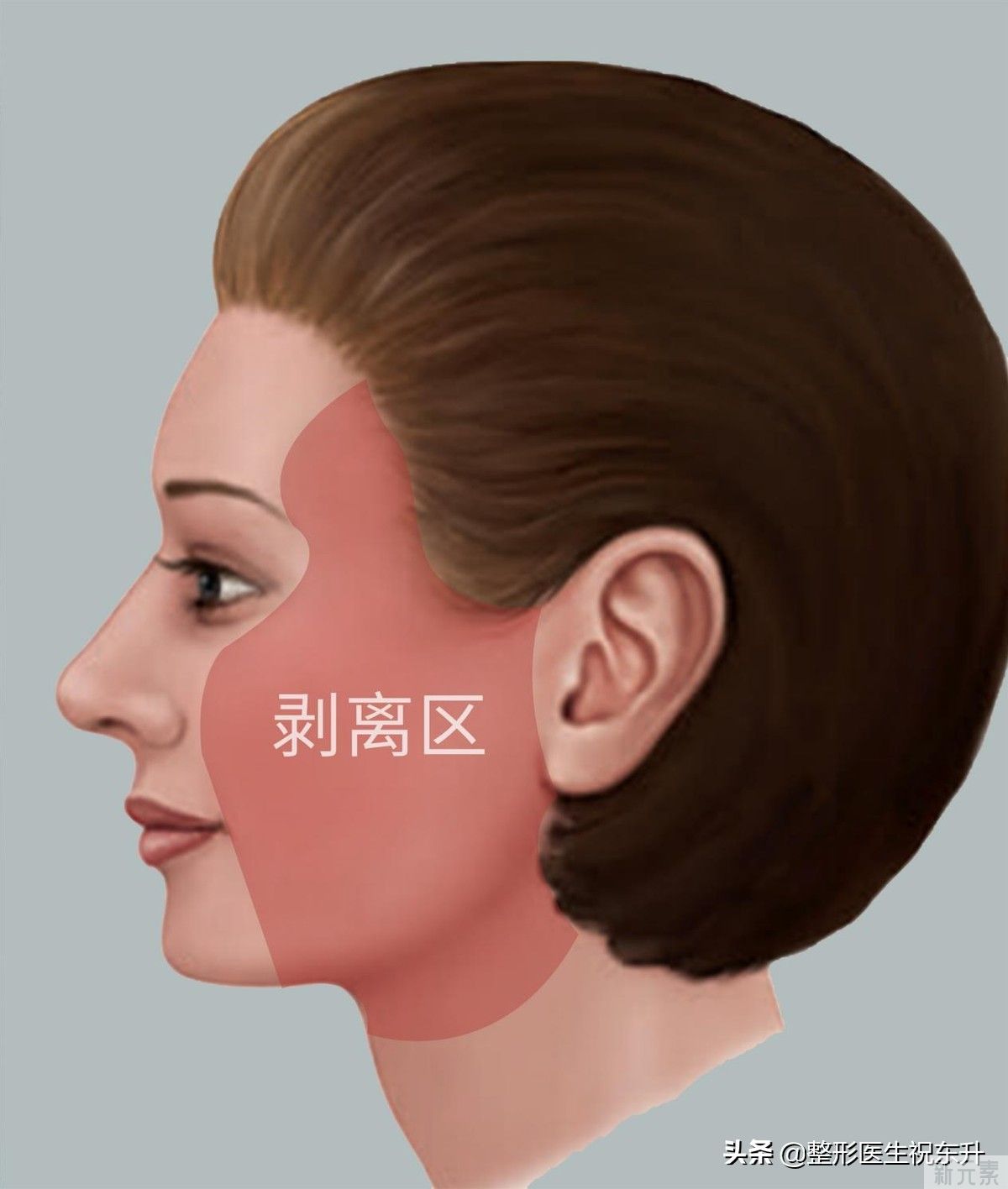 剥离范围大，创伤大，效果越明显?公开拉皮手术的重要细节 图片-4
