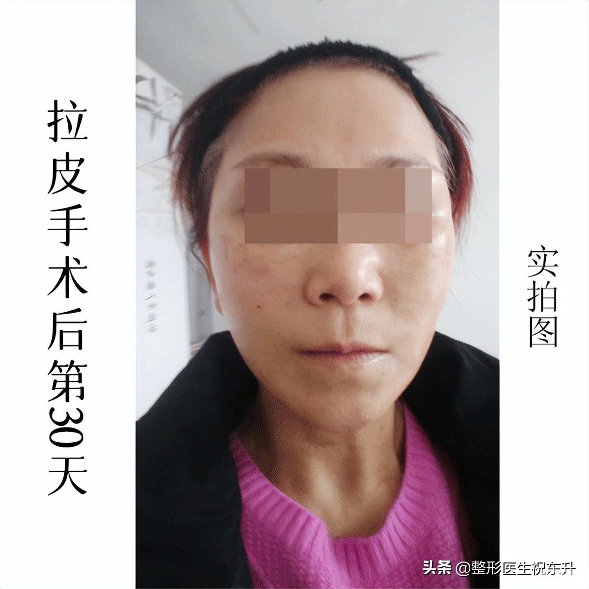剥离范围大，创伤大，效果越明显?公开拉皮手术的重要细节 图片-6