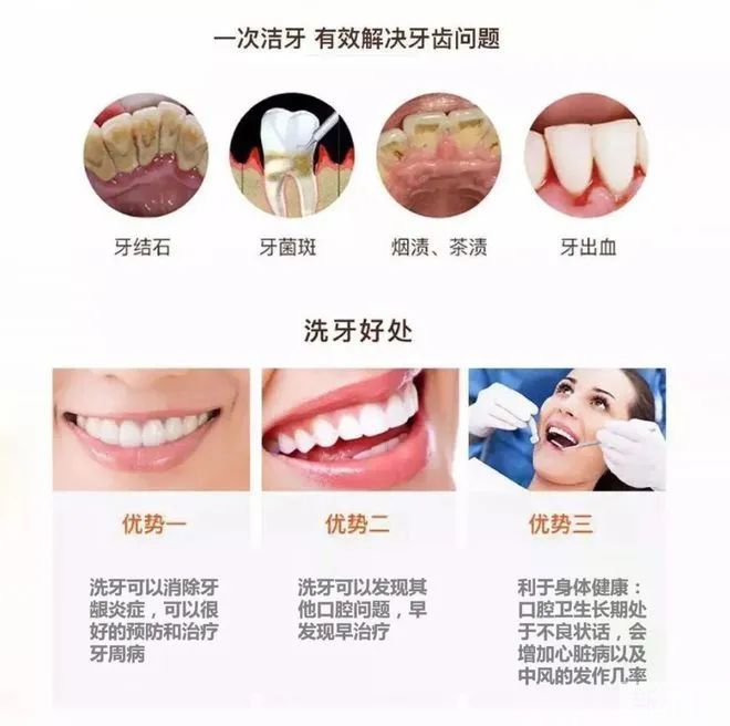 你的牙齿有结石吗?你知道牙结石为什么是臭的? 图片-9