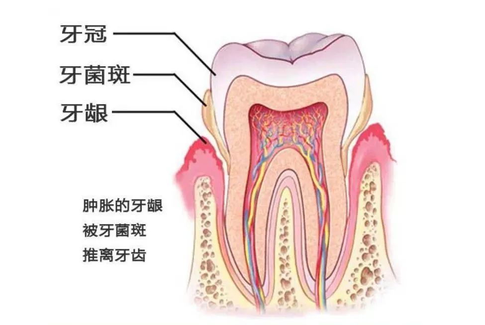 你的牙齿有结石吗?你知道牙结石为什么是臭的? 图片-8