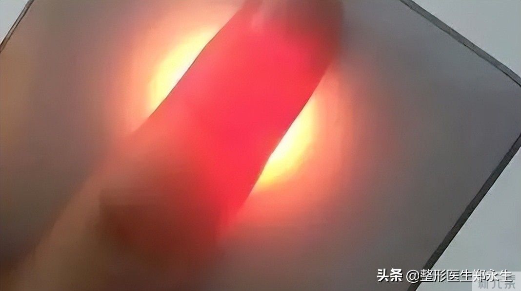科普|为什么有的人隆鼻后会假体透光? 图片-3