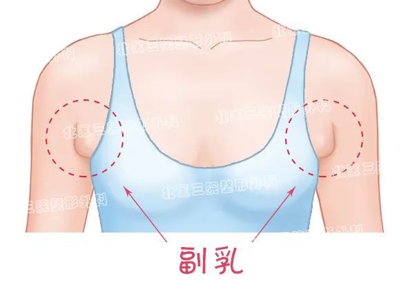 副乳需不需要切除? 图片-1