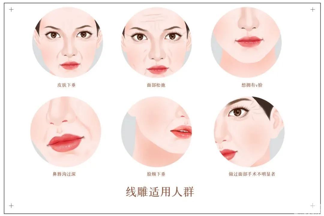 除了拉皮除皱，还有哪些方式能对抗面部松垂凹陷? 图片-3