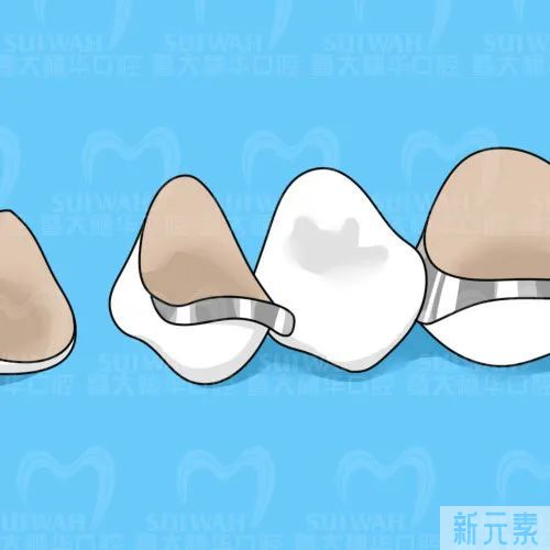 同样是牙冠，为什么价钱差那么多? 图片-5