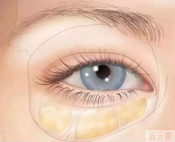 你的眼袋是这样形成的吗? 图片-1