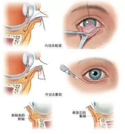你的眼袋是这样形成的吗? 图片-2