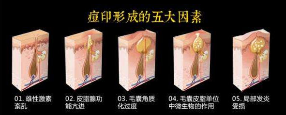 痘痘走了痘印来，痘印为什么更难消除? 图片-4