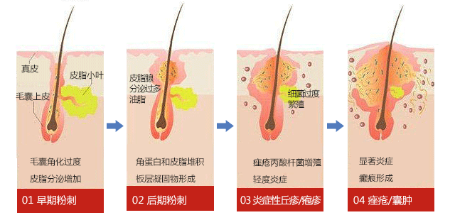 痘痘走了痘印来，痘印为什么更难消除? 图片-2