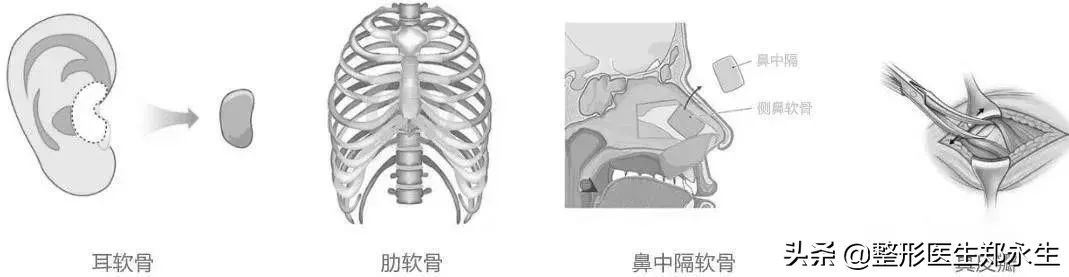 隆鼻材料的区别及其所对应的用途 图片-5