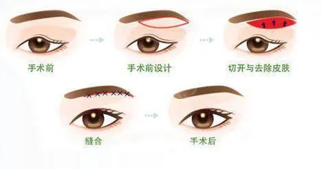 都说提眉术“一术多效”，来看看它如何拯救眼部衰老 图片-5