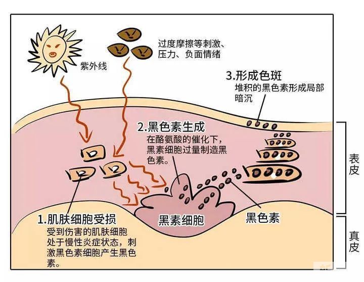 大铁淡斑丨顽固色斑，该怎么办? 图片-3