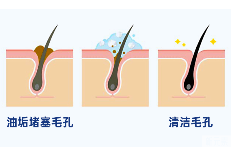 植发后头皮屑特别多，应该怎么办? 图片-3