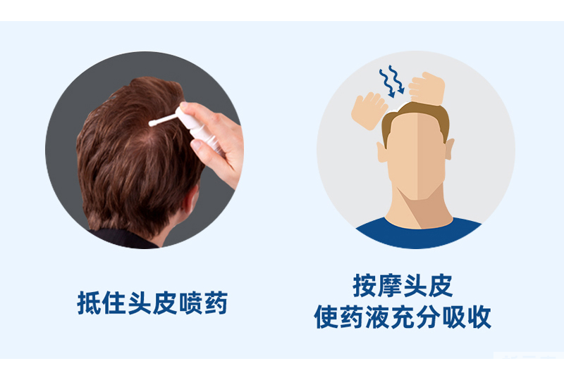 植发后头皮屑特别多，应该怎么办? 图片-4