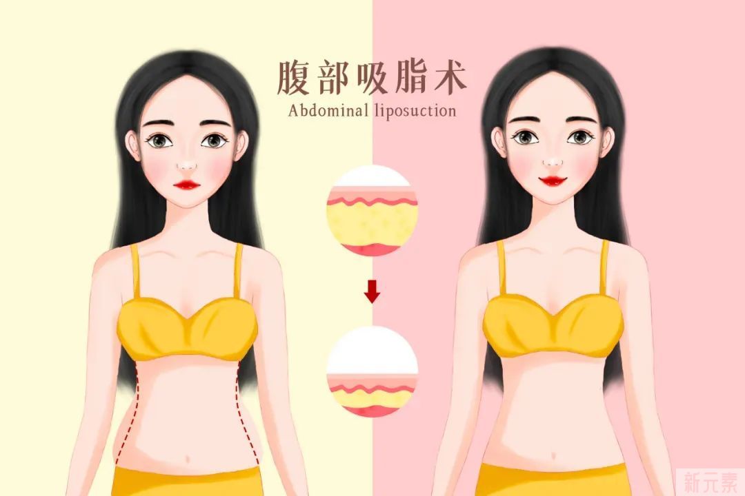 为什么有些人吸脂后美上天，为什么有些人却 图片-7