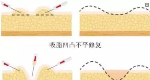 为什么有些人吸脂后美上天，为什么有些人却 图片-9