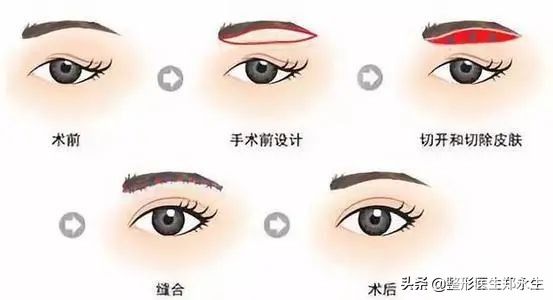 眶周老化的表现和治疗策略 图片-4