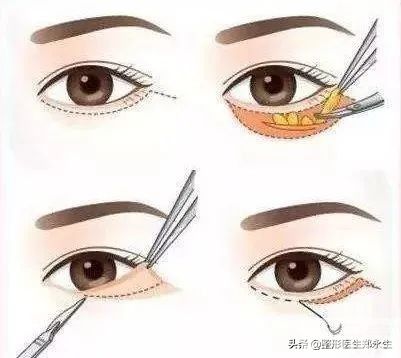 眶周老化的表现和治疗策略 图片-7