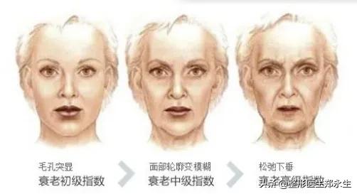 中下面部衰老的细节表现 图片-1