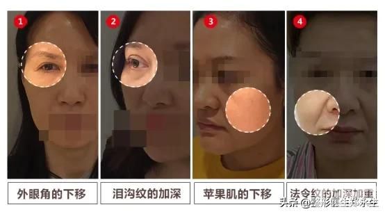 中下面部衰老的细节表现 图片-2