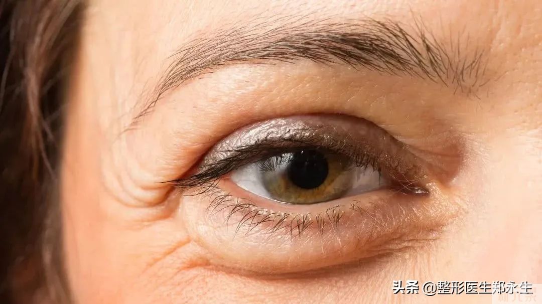 不同类型眼袋的症状和治疗方案 图片-2
