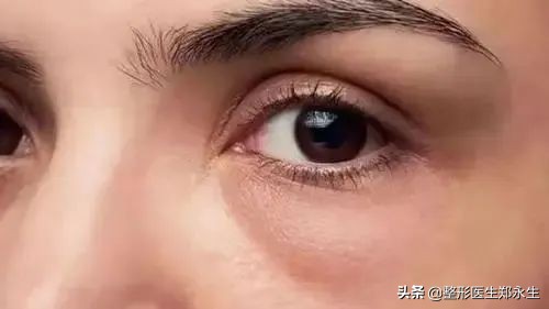 不同类型眼袋的症状和治疗方案 图片-1