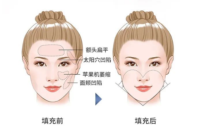 玻尿酸填充5大真相丨如何填出自然高级感? 图片-3