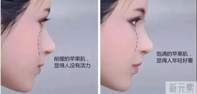 玻尿酸填充5大真相丨如何填出自然高级感? 图片-11