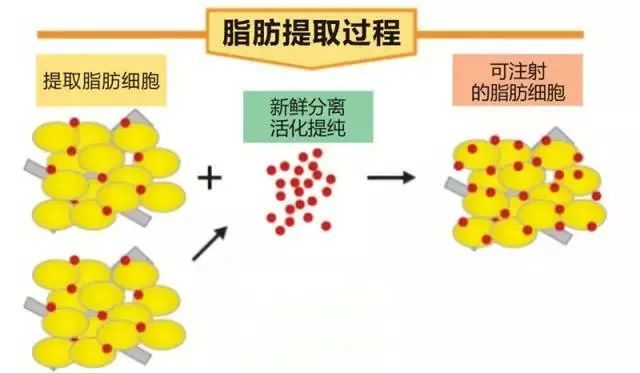 自体脂肪怎么将 “扁平臀”变“蜜桃臀” 图片-5