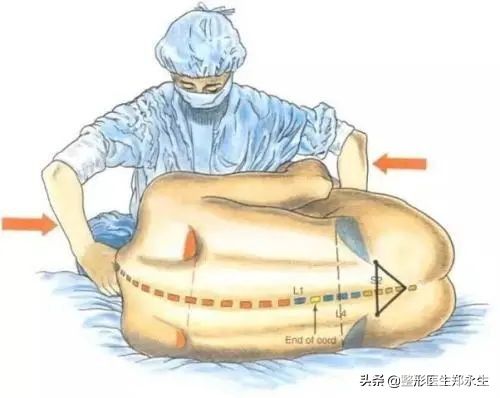 手术时麻醉该怎么选择? 图片-2
