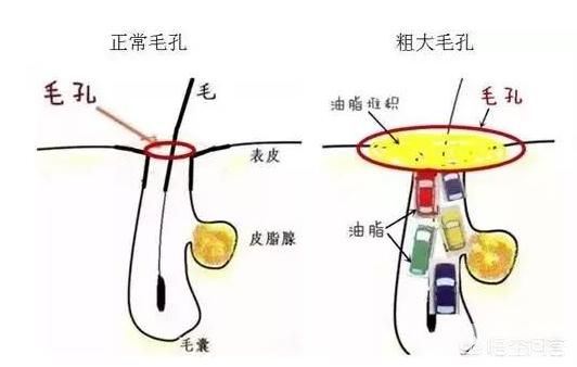 男士毛孔粗大怎么解决? 图片-2