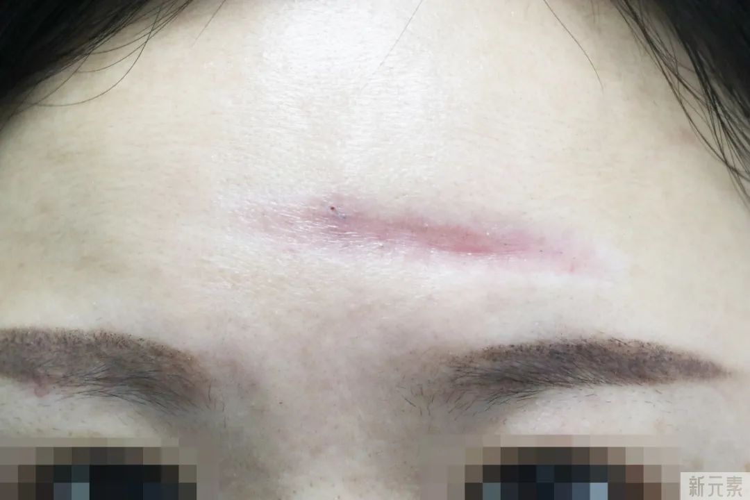 凹陷疤痕有哪几种类型?自己的疤痕又属于哪种? 图片-8