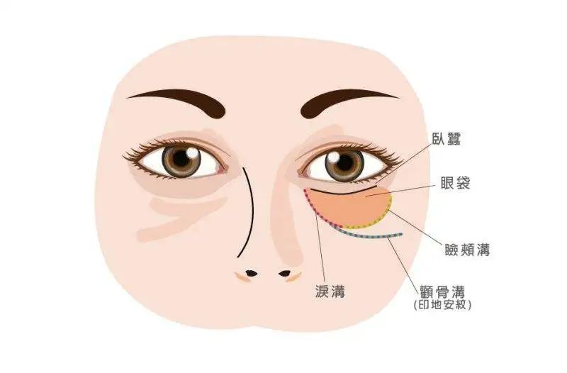 年轻人不长眼袋?这些祛眼袋的误区，你信了几个? 图片-10