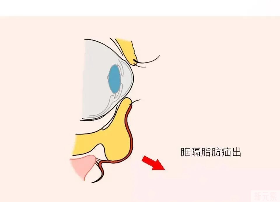 年轻人不长眼袋?这些祛眼袋的误区，你信了几个? 图片-7