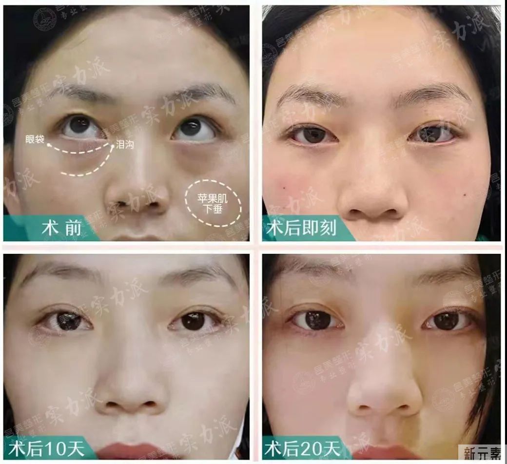 年轻人不长眼袋?这些祛眼袋的误区，你信了几个? 图片-19