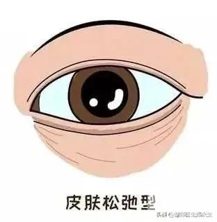 分型而治，眼袋的类型和治疗方式 图片-3