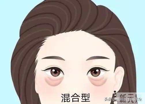 分型而治，眼袋的类型和治疗方式 图片-4
