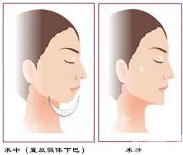 【医美小科普】改善面部轮廓从下巴开始 图片-5