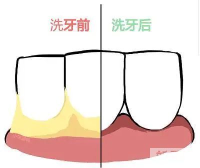 牙齿护理这些雷区，89%的人碰过! 图片-4