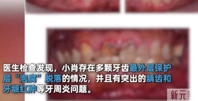 可乐当水喝，牙齿会变脆，详解可乐对牙齿的危害 图片-5
