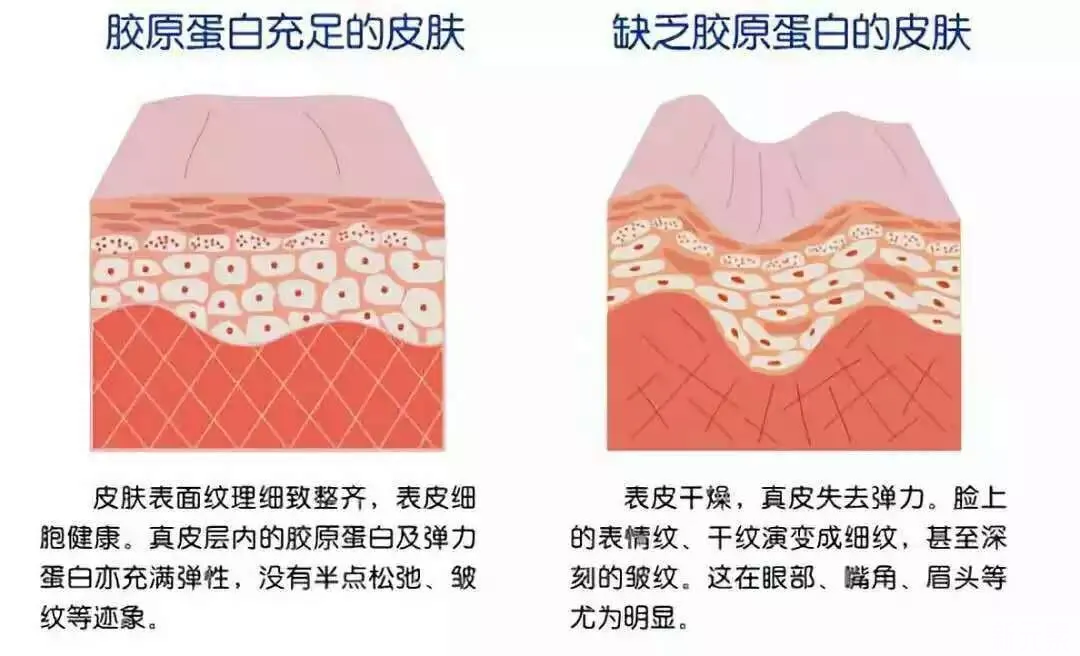 20岁做热玛吉会不会太早了? 图片-6