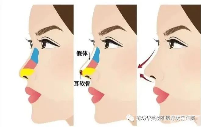 为什么有的人假体隆鼻后会出现鼻背透光的现象?这正常吗? 图片-3