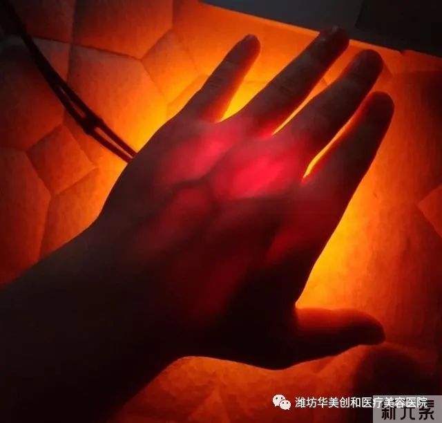 为什么有的人假体隆鼻后会出现鼻背透光的现象?这正常吗? 图片-5