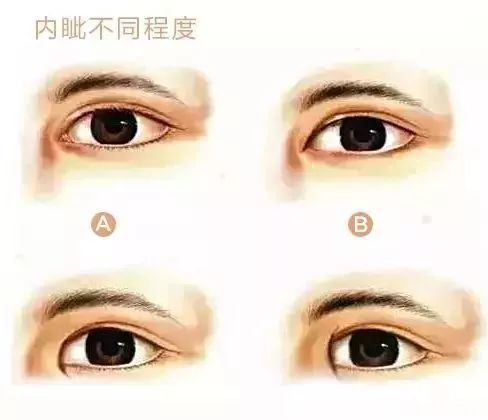 做双眼皮到底要不要开眼角? 图片-3