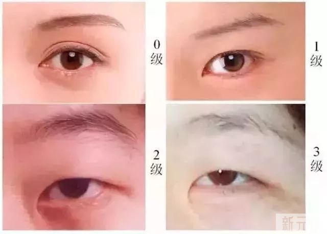 做双眼皮到底要不要开眼角? 图片-6
