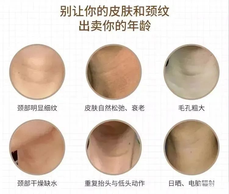 【干货来了】医美“红人”嗨体祛颈纹真的安全么? 图片-9