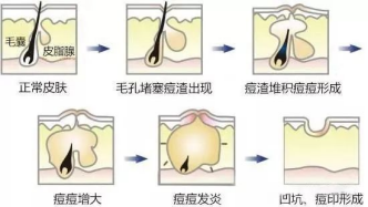 如何预防痘印形成呢?这篇文章告诉你 图片-5