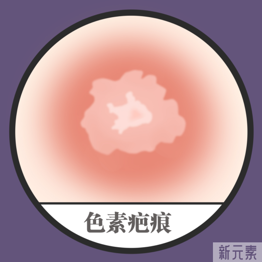 面部多年色素疤痕，还能消退吗? 图片-6