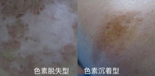 面部多年色素疤痕，还能消退吗? 图片-3