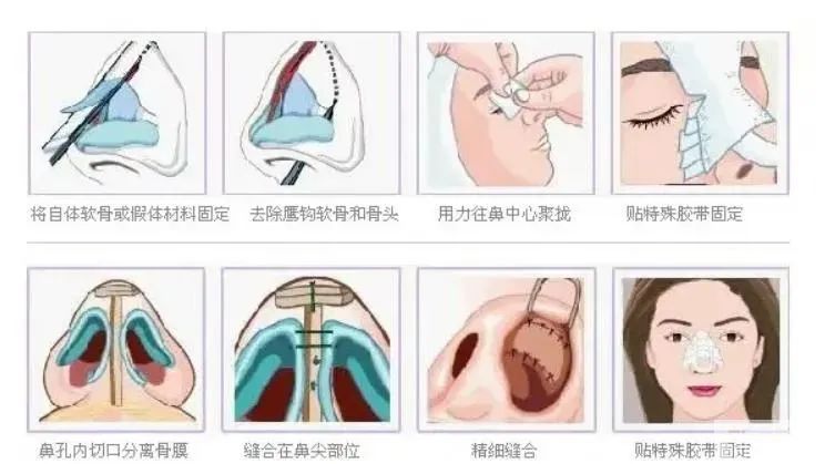 鼻修复之前，必须了解的靠谱知识! 图片-7