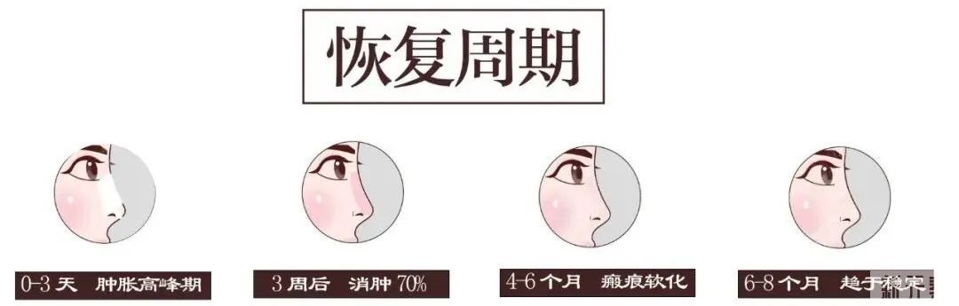 鼻修复之前，必须了解的靠谱知识! 图片-6